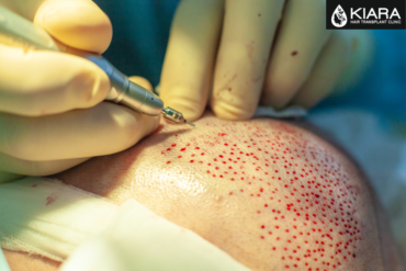 Transform Your Look with the Best Hair Transplant in Chandigarh