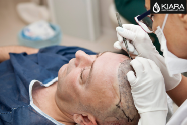 Unveiling the Best Hair Transplant Clinic in Chandigarh