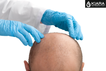 Achieve Natural-Looking Hair with Kiara Hair Transplant Clinic