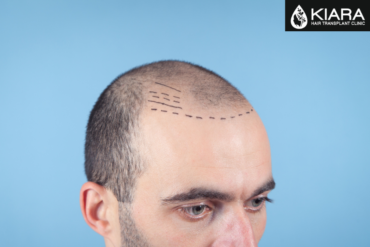 Unraveling the Costs of Hair Transplants in Chandigarh: A Guide by Kiara Hair Transplant Clinic
