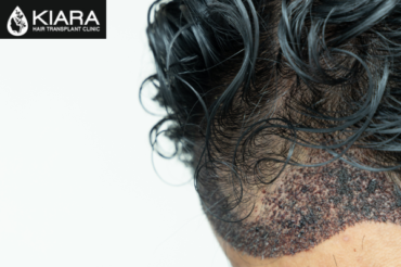 Fue Hair Transplant Clinic in Chandigarh