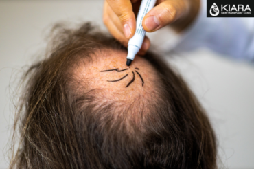Comprehensive Guide to Hair Transplant Costs in Chandigarh